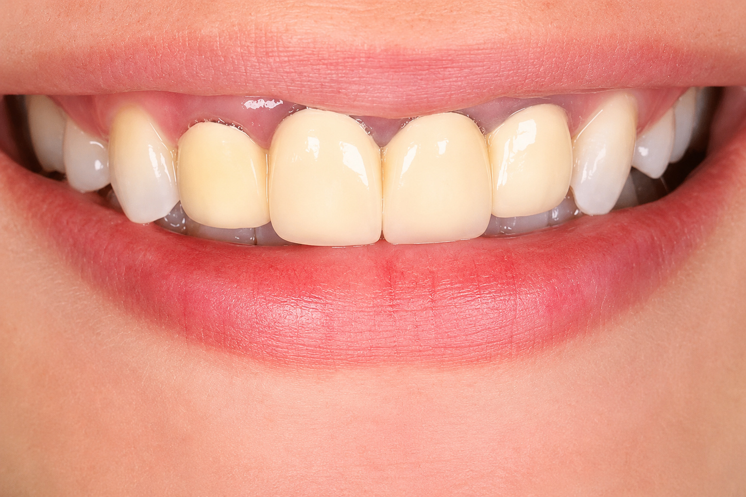 Porcelain Crowns - Before